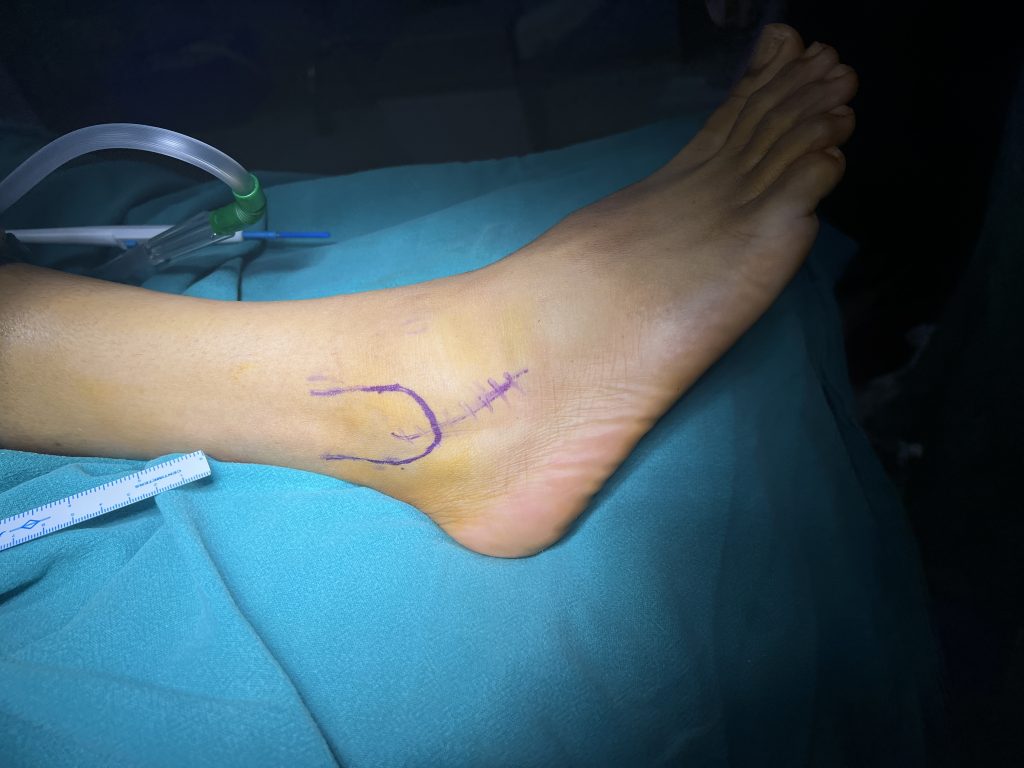 Foot and ankle specialist in Ahmedabad Dr Ankit Kamothi