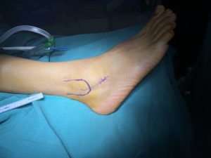 Why Early Foot & Ankle Care Can Prevent Surgery – Dr Ankit Kamothi, Ahmedabad